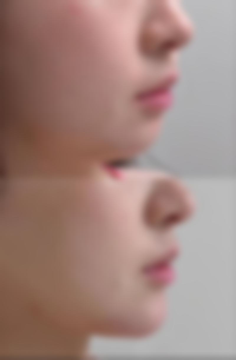 武汉艺君美韩医疗美容医院万惠芳医生膨体隆鼻技术怎么样？