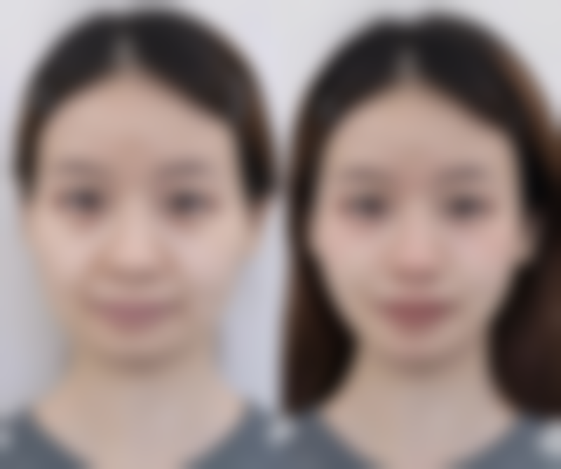 这3步淡化修复法成效究竟如何呢?