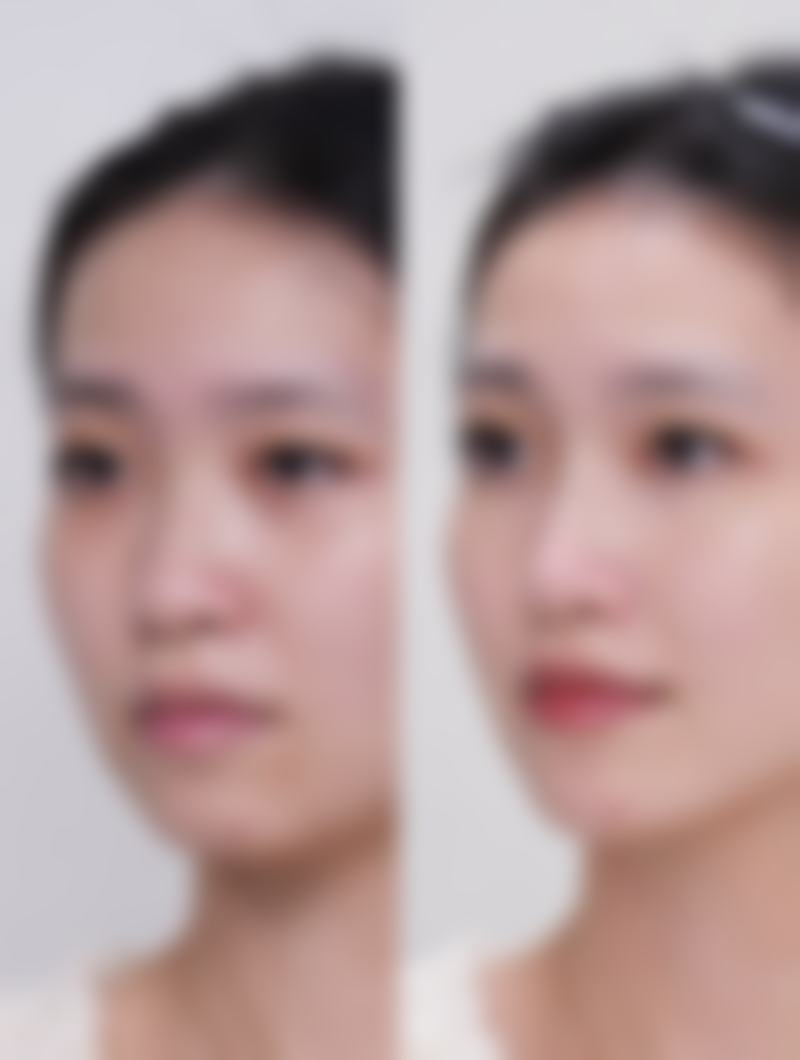 告别熊猫眼!妙招三:手术治疗,完全解决顽固问题