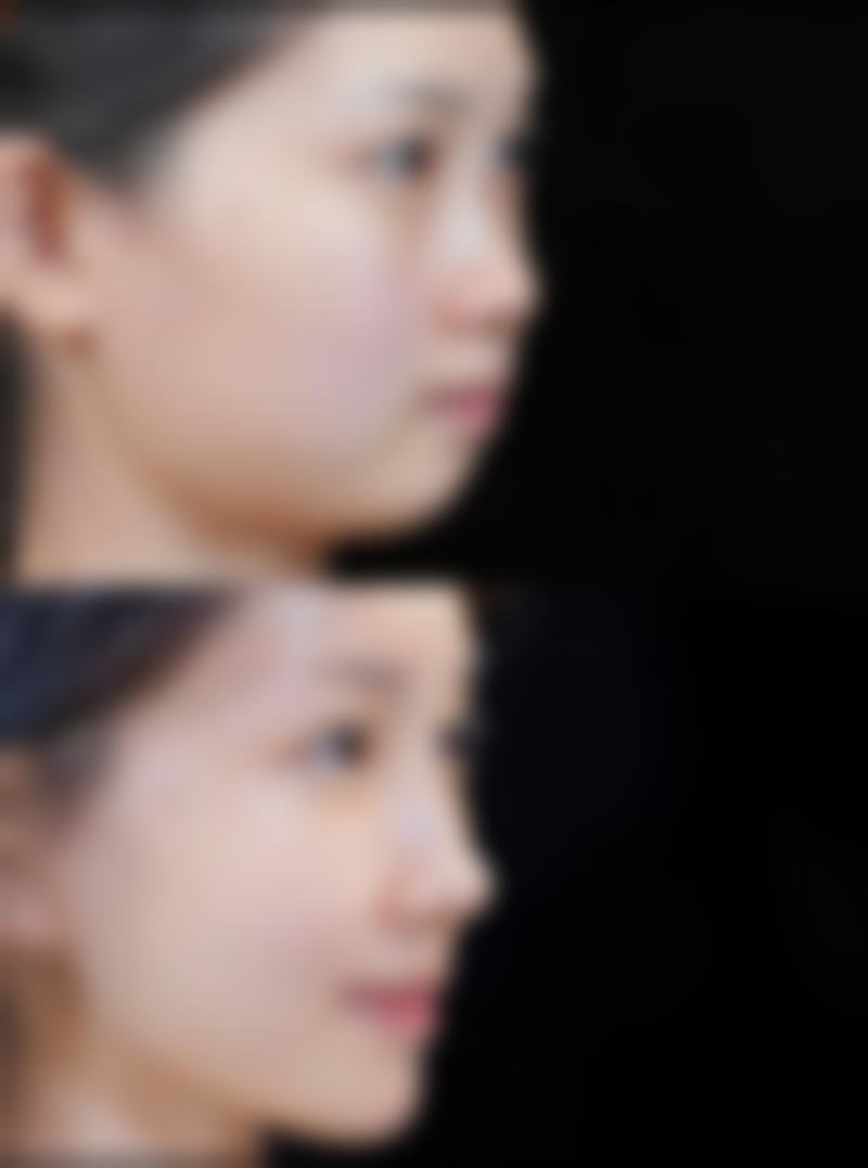 大庆郭永波医疗美容诊所郭永波医生自体软骨隆鼻技术怎么样?