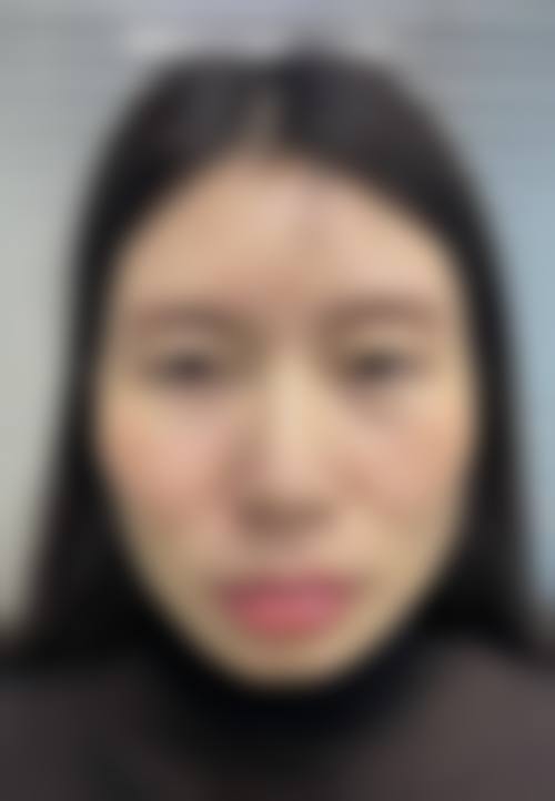 优惠活动详情:定点双眼皮原价22517元-优惠价15800元