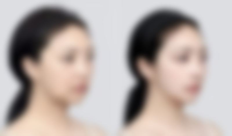 如果在割双眼皮20天抽烟了会怎样?