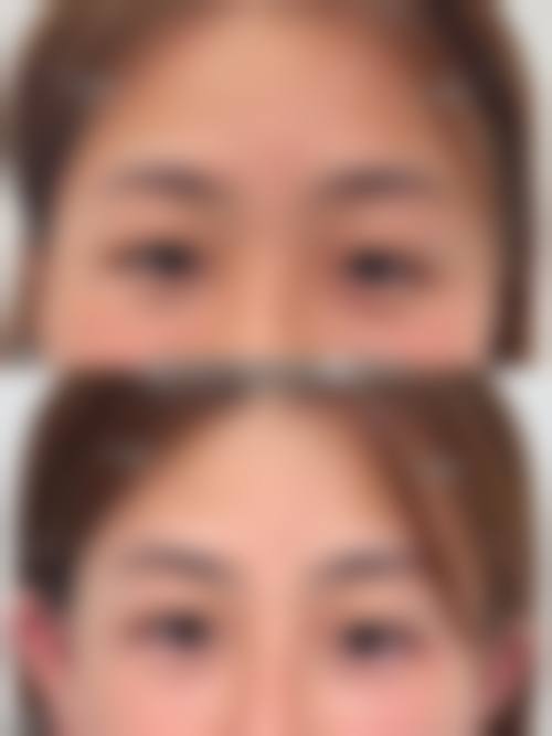 优惠活动详情:光子嫩肤体验价限时开启