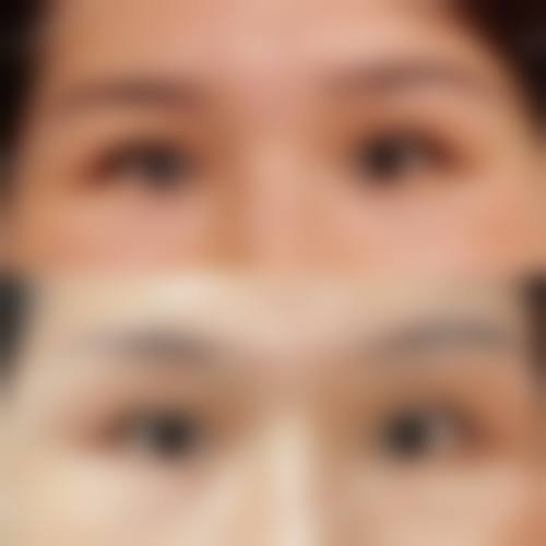 临床实例分享 王力佳 广州南珠整形美容